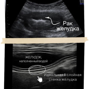 УЗИ желудка. Снимки патологии и нормы.
