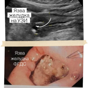 Подтверждённый диагноз язвы желудка на УЗИ и ФГДС