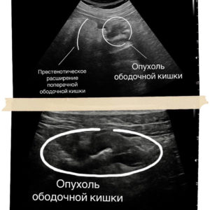 Предстенотическое расширение поперечной ободочной кишки