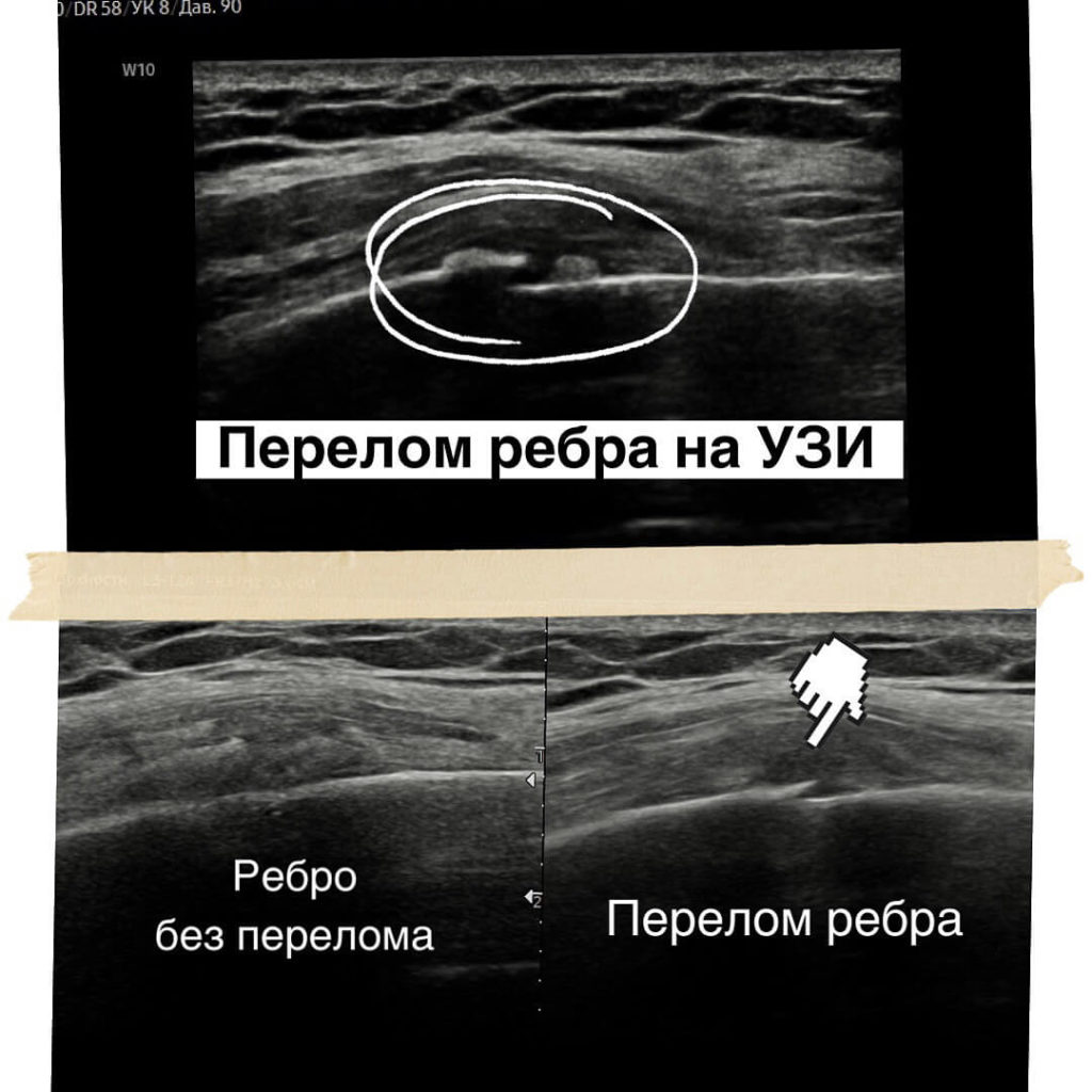 Перелом ребра на УЗИ