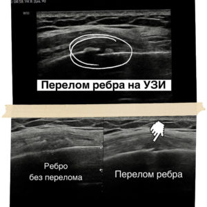Перелом ребра на УЗИ