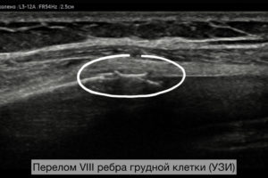 Перелом ребра на УЗИ