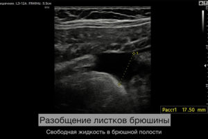 Разобщение листков брюшины