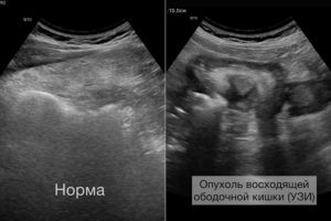 Опухоль восходящей ободочной кишки