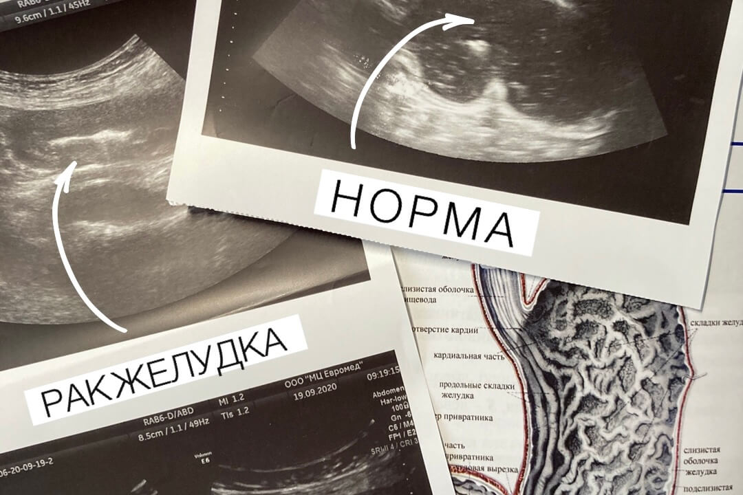 Желудок в норме на снимке УЗИ, рак желудка на снимке УЗИ