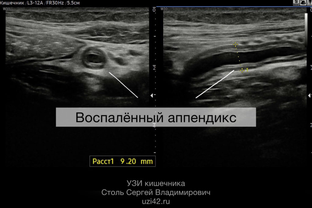 УЗИ ЖКТ Снимок воспалённого аппендикса