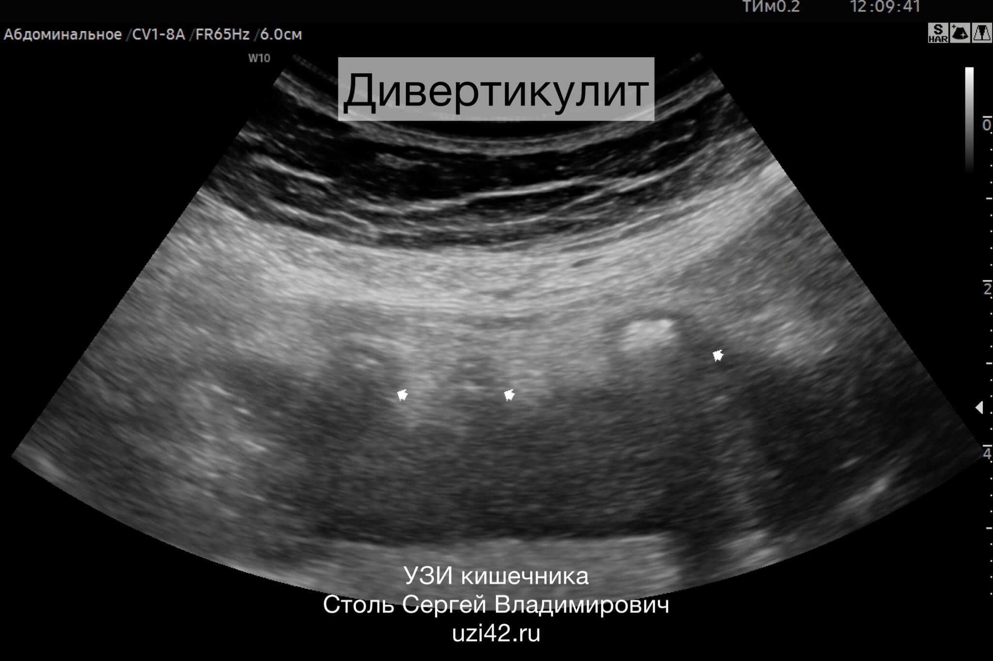 Снимок УЗИ кишечника с дивертикулитом на УЗИ ЖКТ