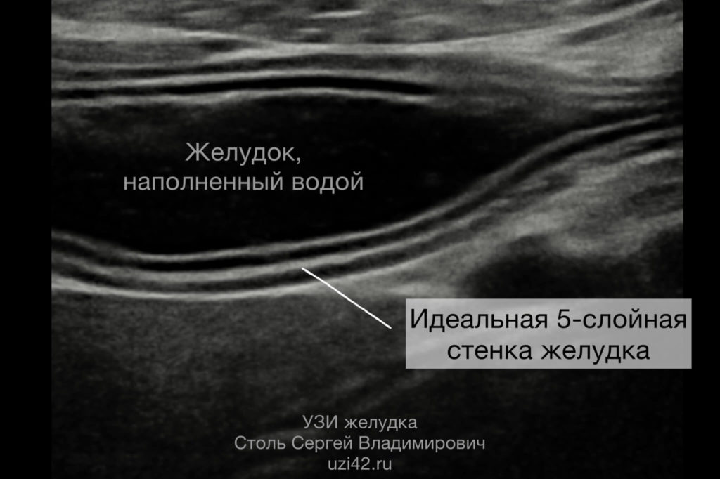 Снимок УЗИ желудка, наполненного водой, на котором отлично видно 5-слойную стенку желудка