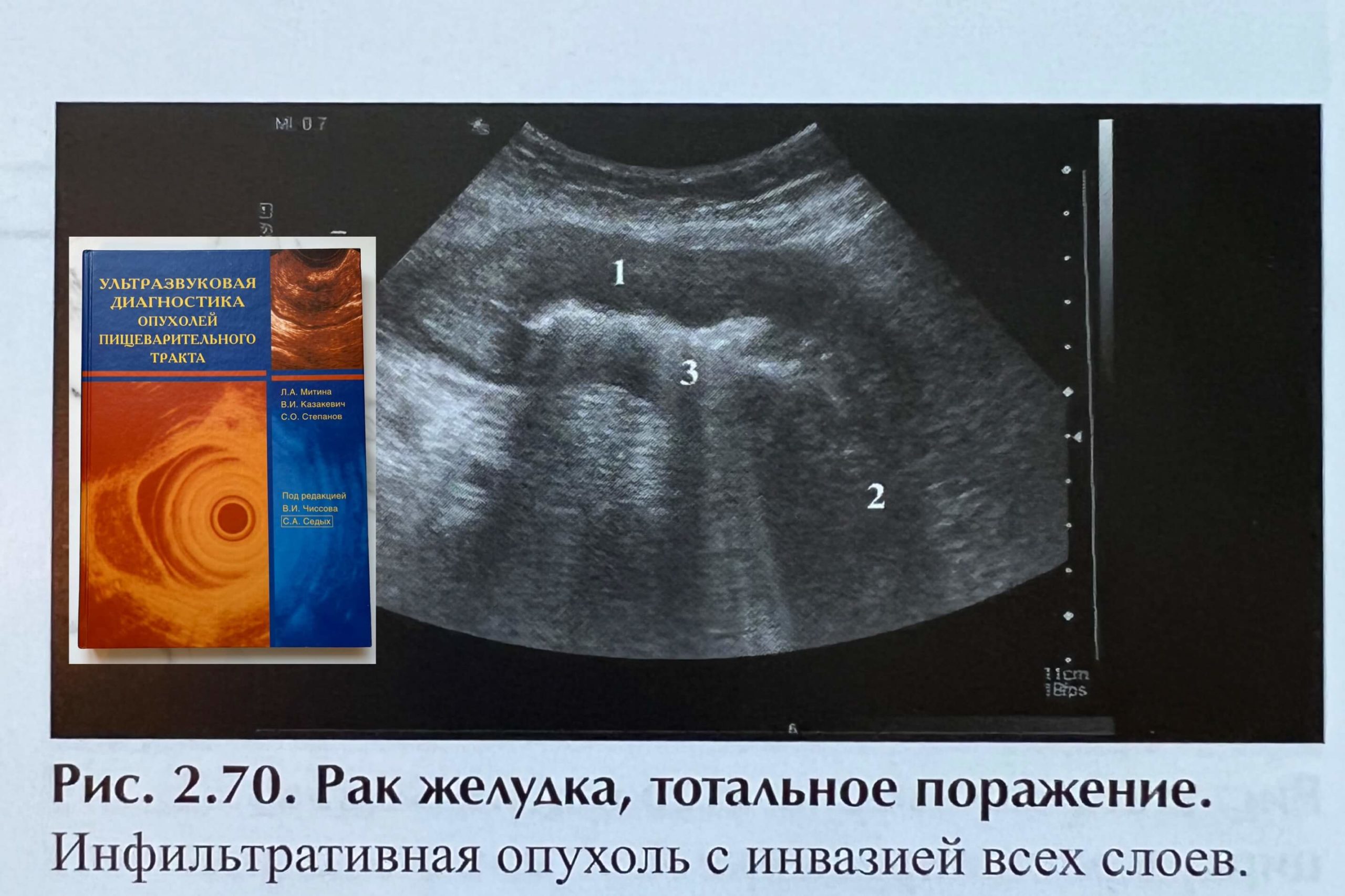 Снимок рака желудка на УЗИ
