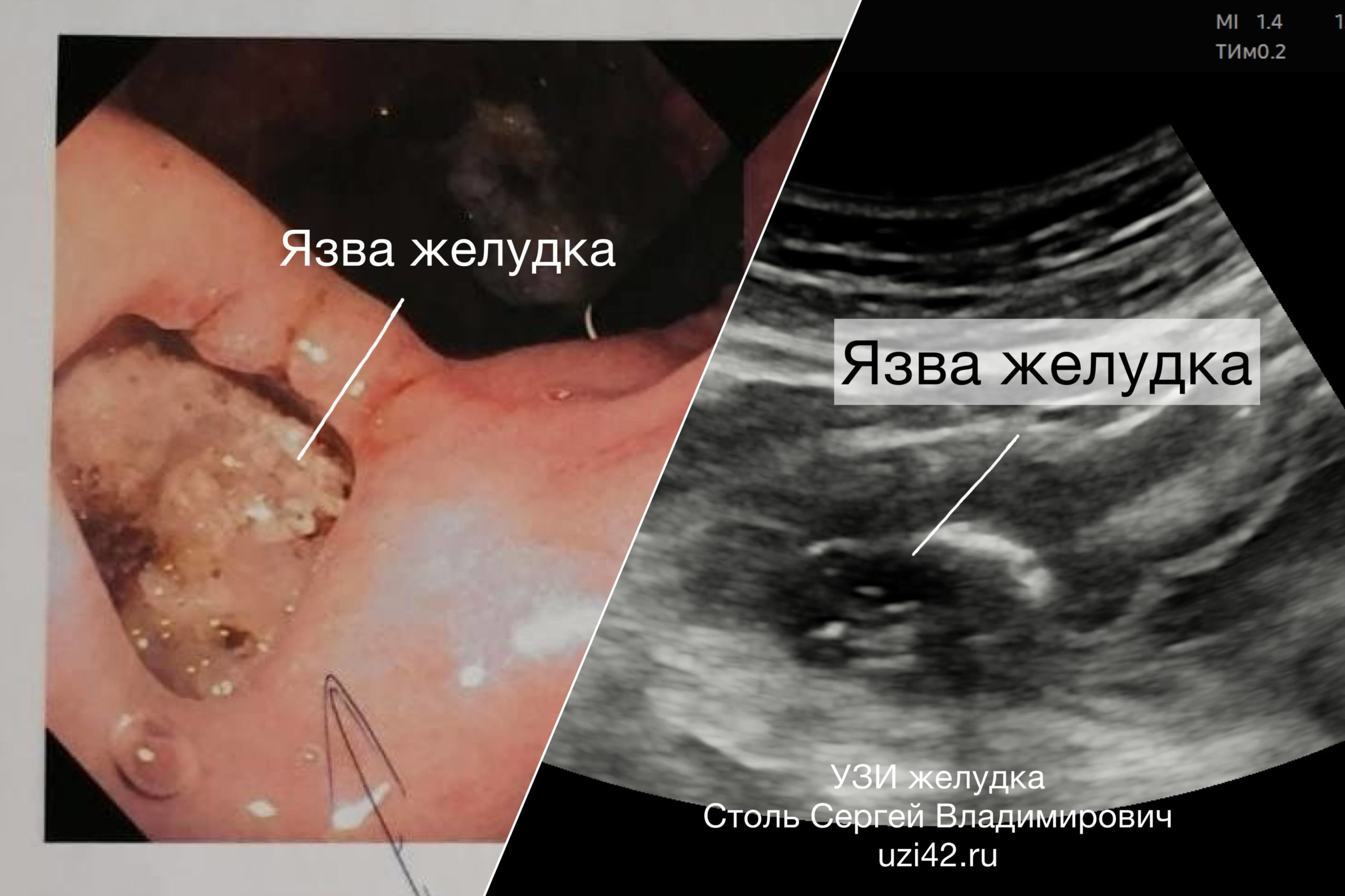 Снимок язвы желдука на УЗИ и фото той же язвы желудка из протокола ФГДС