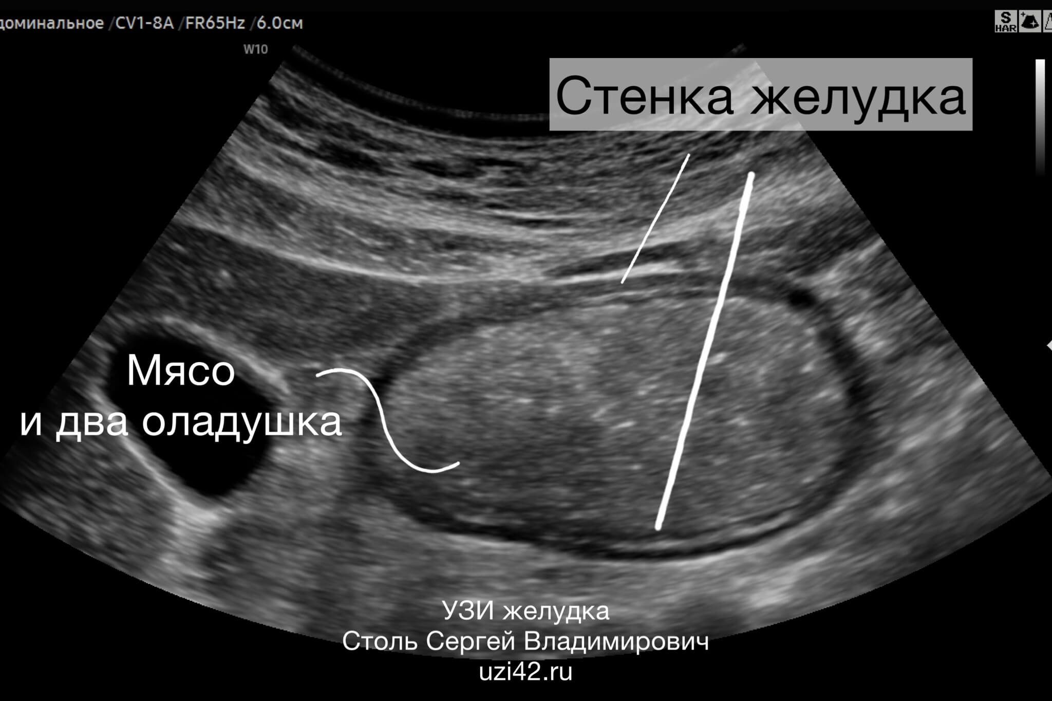 Снимок УЗИ ЖКТ, на котором отлично видно желудок и его содержимое