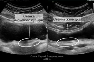 Сравнение визуализации мочевого пузыря и желудка на УЗИ