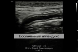 Воспалённый аппендикс виден на УЗИ