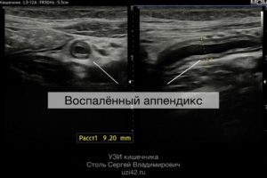 Воспалённый аппендикс виден на УЗИ