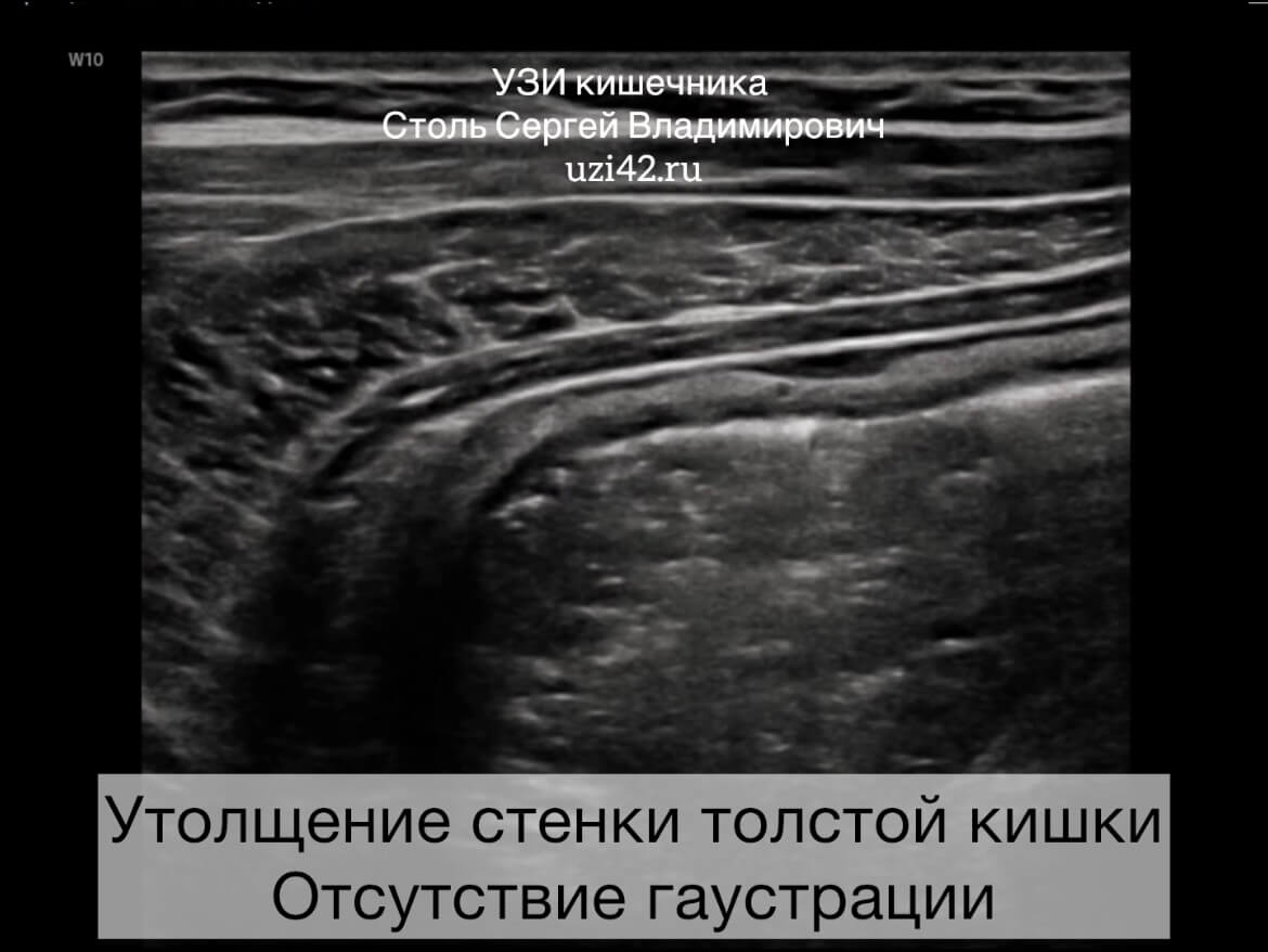 УЗИ ЖКТ Снимок УЗИ кишечника при неспецифическом язвенном колите, на котором видно утолщений стенки толстой кишки, отсутствие гаустрации