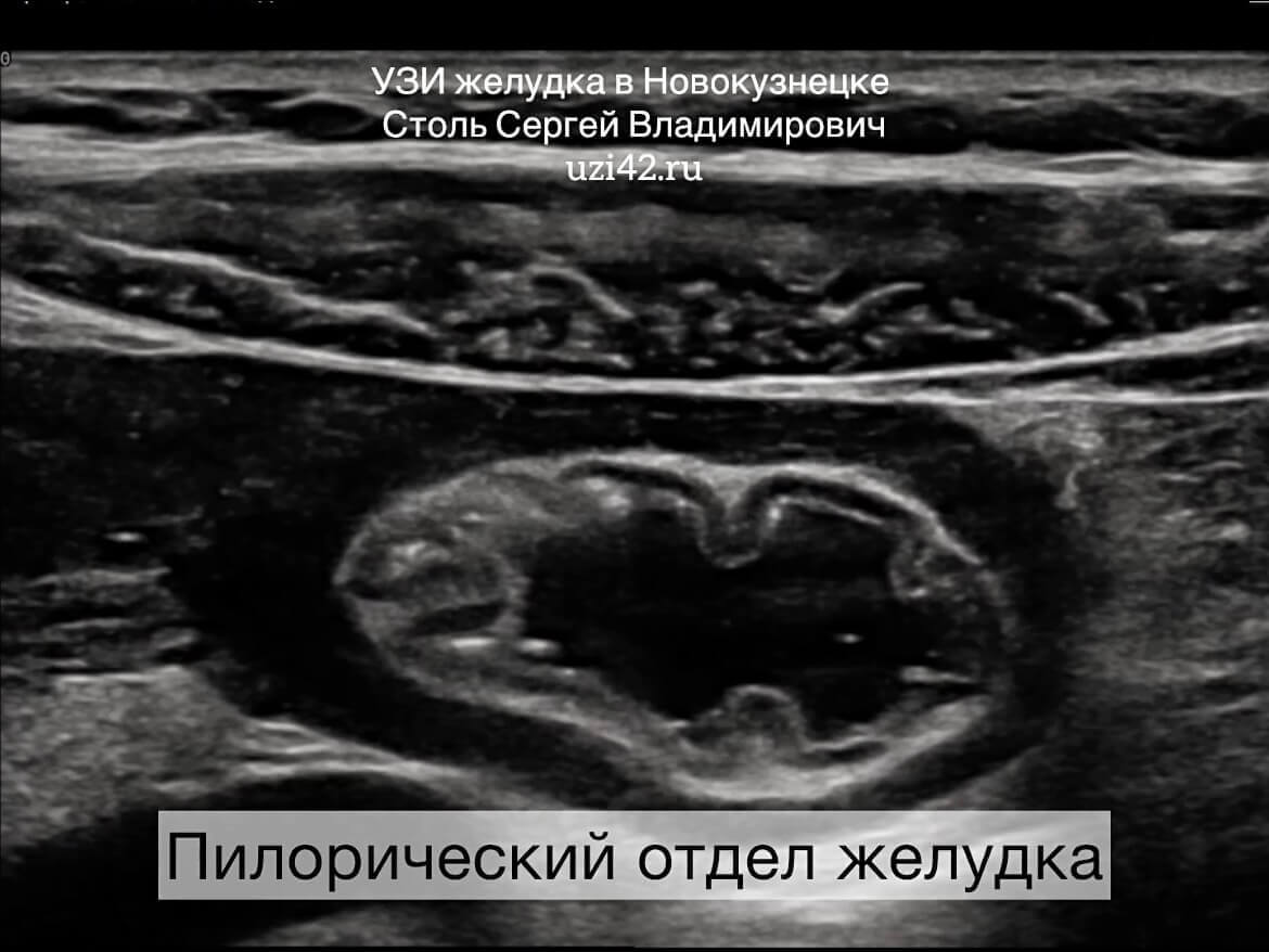 Пилорический отдел желудка на УЗИ ЖКТ