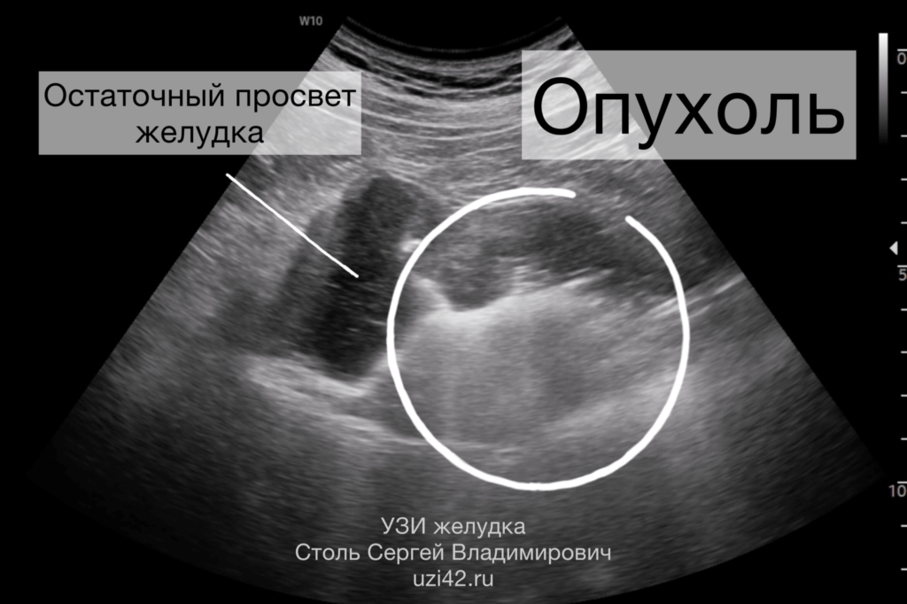 Снимок УЗИ желудка с опухолью