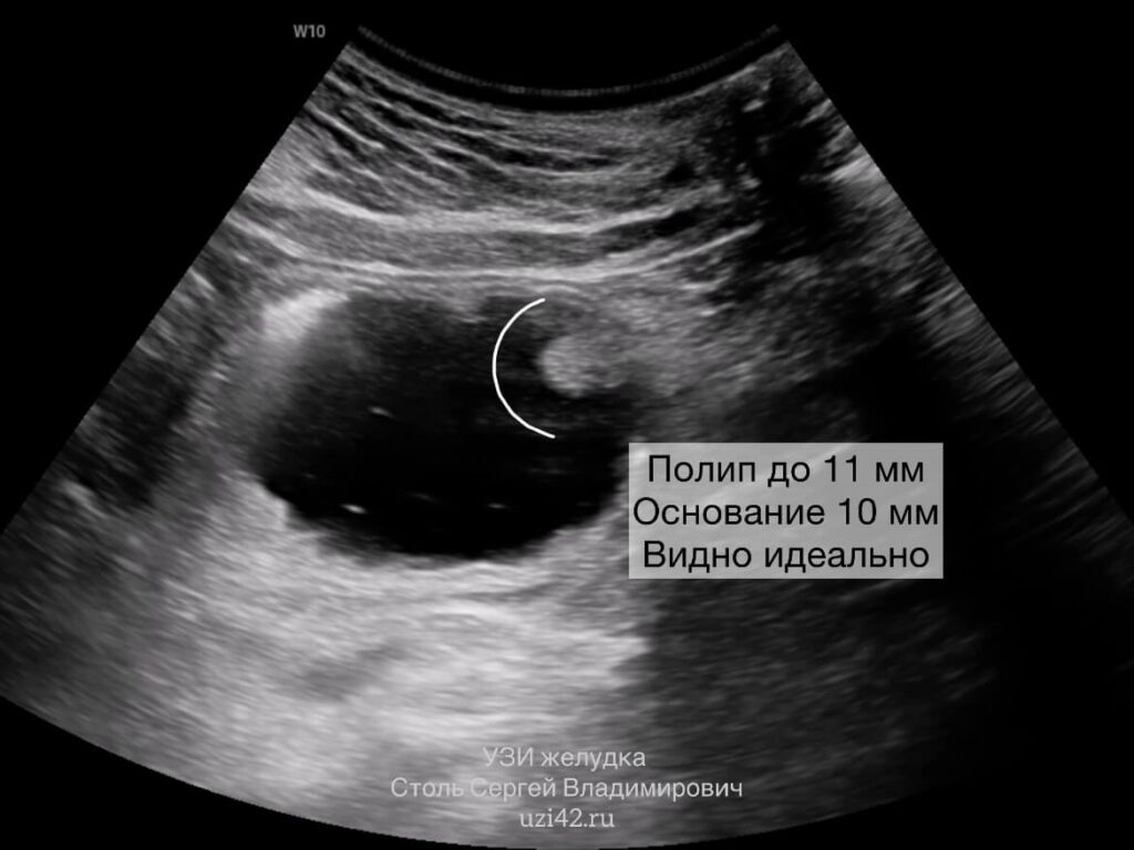 Снимок УЗИ желудка