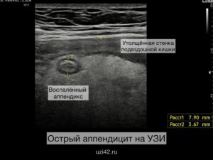 Снимки УЗИ с воспалённым аппендиксом и утолщённой стенкой подвздошной кишки