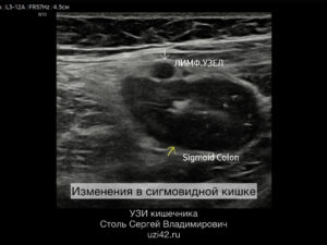 Снимок УЗИ с изменениями в сигмовидной кишке